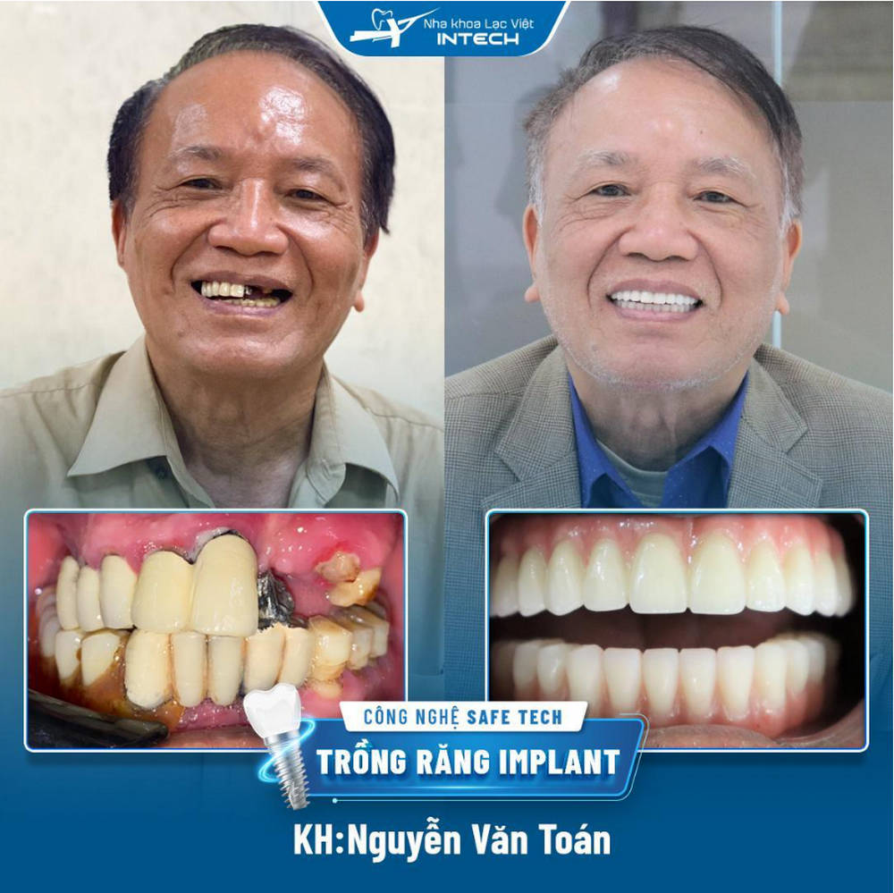 Phục hình răng mất bằng trồng răng implant tại Nha khoa Lạc Việt Intech
