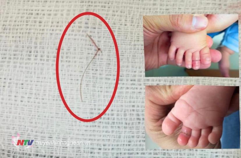 Hình ảnh sợi tóc được lấy ra khỏi ngón chân trẻ