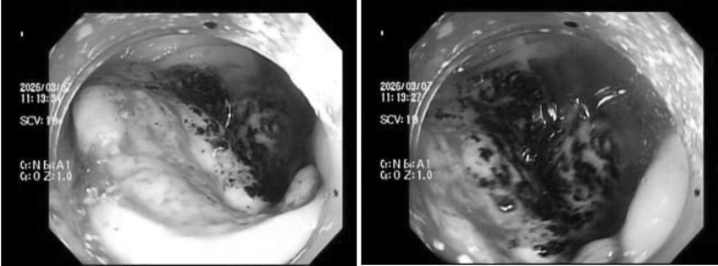 Hình ảnh nội soi ung thư. Ảnh: BSCC.