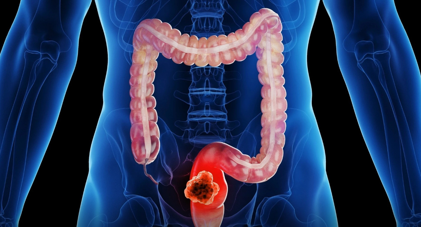 Ung thư đường tiêu hóa thường không có dấu hiệu rõ ràng, khiến người bệnh khó phát hiện sớm. Ảnh: Shutterstock.