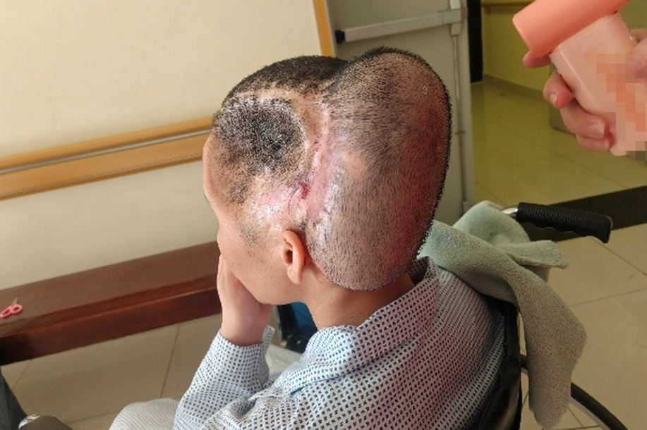 Cô gái nguy kịch và biến dạng vùng đầu nặng nề sau phẫu thuật thẩm mỹ (Ảnh: BV).