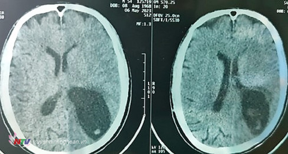  Hình ảnh chụp sọ não bệnh nhật S.V.T trước khi phẫu thuật.