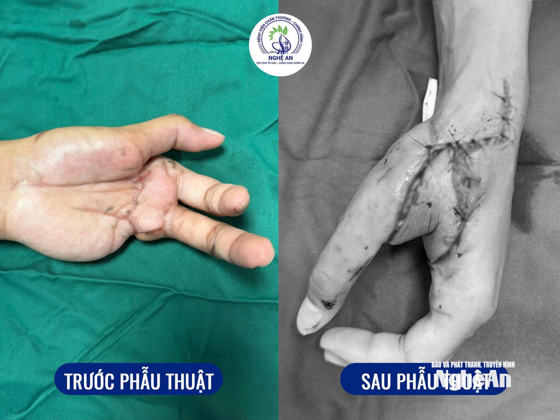 Ê-kíp các bác sĩ Bệnh viện Chấn thương - Chỉnh hình Nghệ An thực hiện kỹ thuật chuyển vạt SCIP tự do tạo hình bàn tay. Ảnh: Đậu Huyền