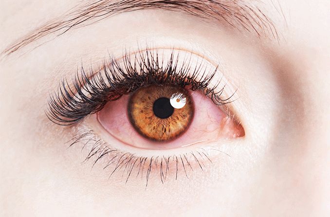 Sử dụng mascara hoặc sản phẩm mắt kém chất lượng có thể gây ra viêm kết mạc.