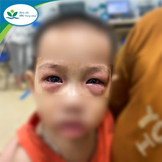 Trẻ đau mắt đỏ điều trị tại Bệnh viện Nhi Trung ương.