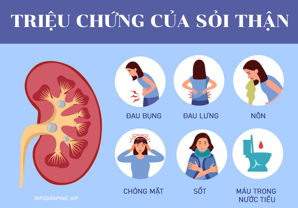 Các triệu chứng của sỏi thận. Infographic: AIP