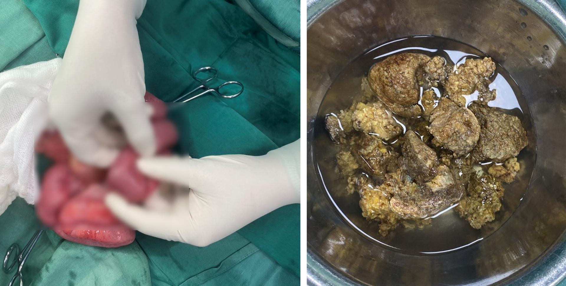 Hình ảnh bã thức ăn bít tắc trong lòng ruột và bã thức ăn sau khi được phẫu thuật lấy ra sau ca phẫu thuật
