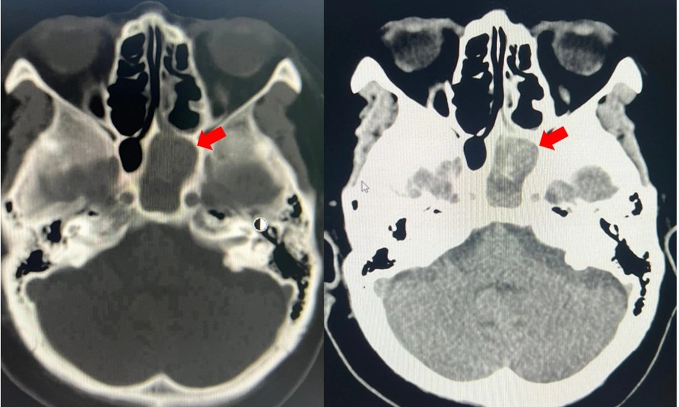 Hình ảnh khối nấm xoang bướm bên trái (mũi tên đỏ) (Ảnh: BV).