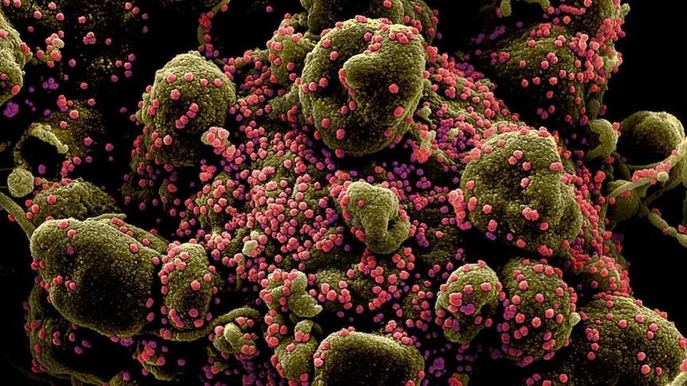 Một tế bào sắp chết (màu nâu lục) bị nhiễm các hạt virus SARS-CoV-2 (màu hồng). Hình ảnh này được phân lập từ một mẫu bệnh phẩm do Viện Dị ứng và Bệnh Truyền nhiễm Quốc gia Mỹ cung cấp.