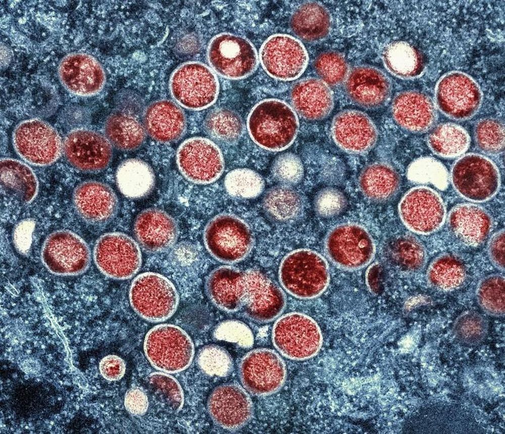 Hình ảnh hiển vi điện tử của virus “đậu mùa khỉ” hay “mpox”. Ảnh: AP
