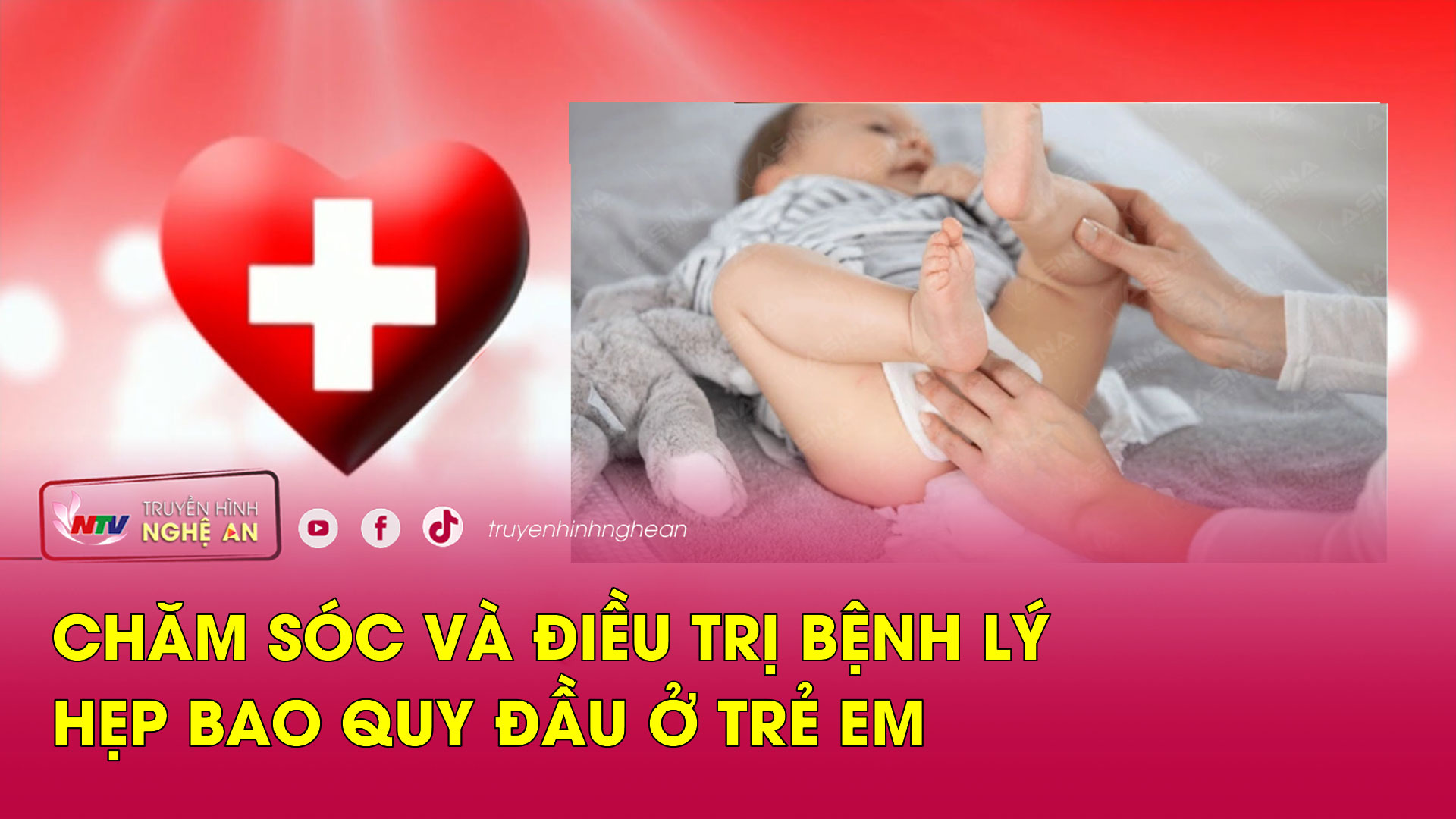 Sức khỏe của bạn: Chăm sóc và điều trị bệnh lý hẹp bao quy đầu ở trẻ em