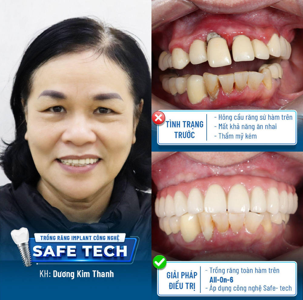 Khách hàng trải nghiệm công nghệ trồng răng Implant bằng công nghệ Safe-tech tại Nha khoa Lạc Việt Intech Vinh