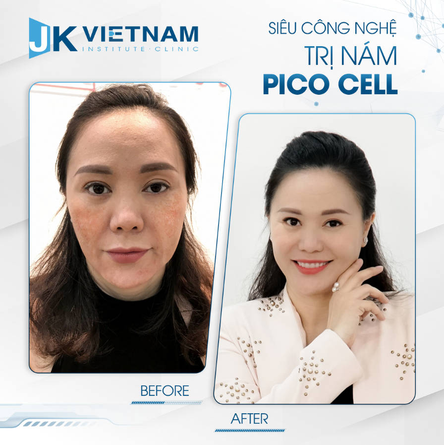 Nữ CEO tự tin với vẻ đẹp không tuổi chỉ sau 1 lần thực hiện điều trị nám Pico Cell duy nhất tại JK Việt Nam. Đơn giản không chỉ là sở hữu làn da sáng mịn mà hơn thế nữa, khách hàng còn phá bỏ được sự tự ti, tạm biệt nám đã đeo đuổi suốt bao năm
