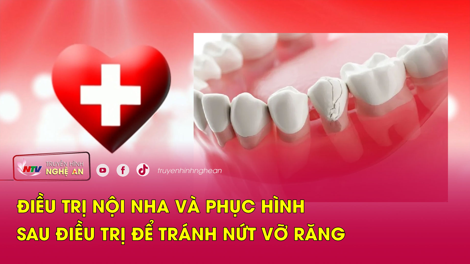 Sức khỏe của bạn: Điều trị nội nha và phục hình sau điều trị để tránh nứt vỡ răng