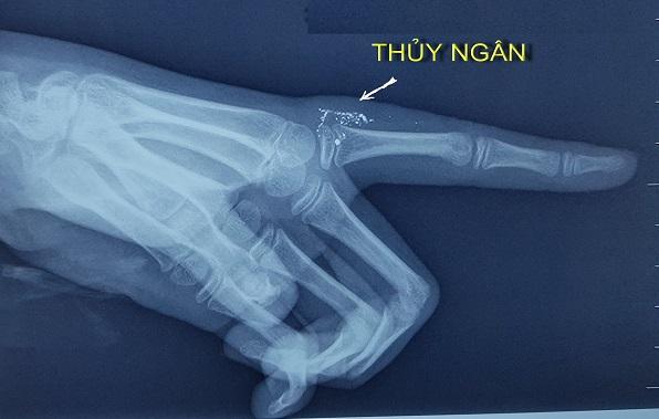 Hạt thủy ngân trong tay qua hình ảnh phim X-quang.