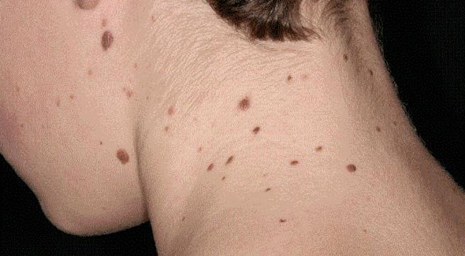 Những nốt ruồi lạ là chỉ dấu ung thư da.