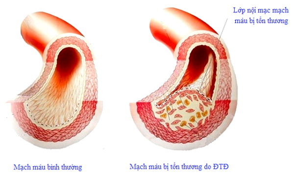 Bệnh tiểu đường và biến chứng mạch máu