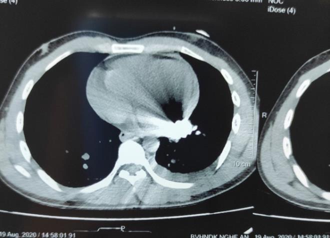Hình ảnh chụp cắt lớp cho thất dị vật kim khí nằm trong tim bệnh nhân.
