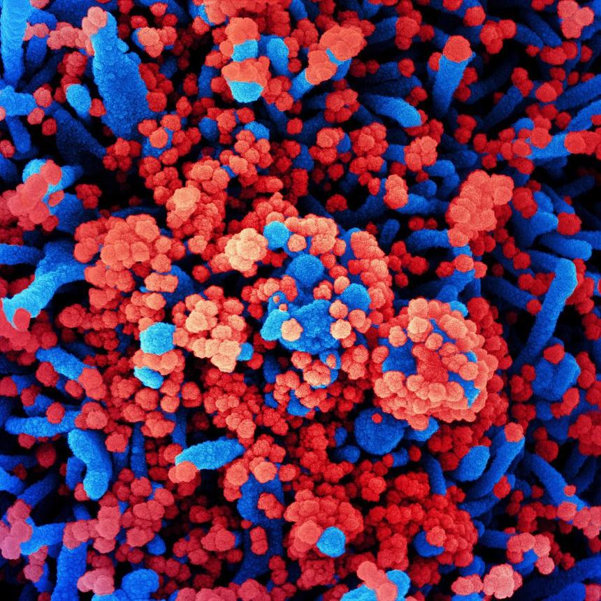 Hình ảnh dưới kính hiển vi điện tử quét màu của một tế bào (màu xanh lam) bị các hạt nCoV (màu đỏ) xâm chiếm. NIAID phân lập từ một mẫu bệnh phẩm. 
