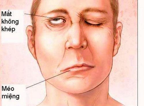 Khi mắc liệt mặt, thường đột ngột thấy hai bên mặt mất cân đối, nửa mặt bên liệt bất động, mất nếp nhăn trán...