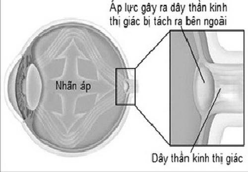 Tăng nhãn áp - một tác dụng phụ nguy hiểm khi dùng thuốc steroid.