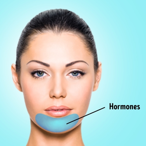 Mụn ở cằm: Phần lớn là do hormones hay nội tiết tố. Mụn cũng xuất hiện ở cằm trong thời kỳ kinh nguyệt của người phụ nữ.