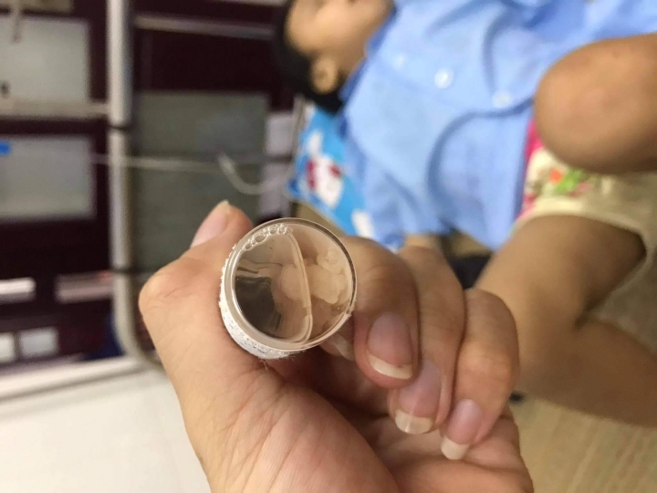 Hình ảnh dị vật ở mũi bé A. trong lần điều trị tại Bệnh viện Nhi Trung ương.