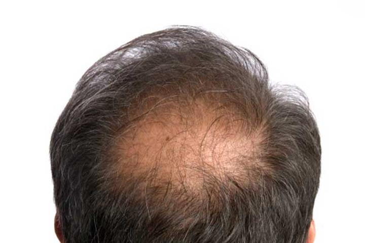 Tóc rụng theo mảng tròn: Nếu tóc bạn rụng triệt để ở một mảng tròn nhỏ, bạn có thể đã mắc bệnh hói đầu. Bệnh tiểu đường có thể kích thích sự phát triển của bệnh hói đầu. Bệnh hói đầu còn có thể khiến lông mày hoặc lông mi rụng, vậy nên hãy chú ý các dấu hiệu để điều trị kịp thời.