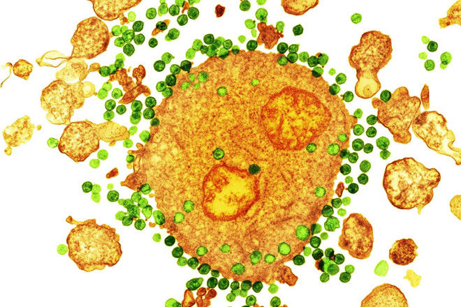 ​  ​ Virus HIV (màu xanh) tấn công các tế bào bạch cầu (màu cam). ​  ​