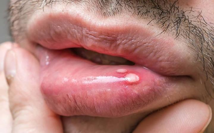 ​  Lở loét hoặc đau ở miệng: Những vết loét miệng thường không đáng lo ngại. Tuy nhiên, nếu bạn nhận thấy vết loét không lành, các mảng trắng hoặc đỏ xuất hiện trên nướu răng, lưỡi và bạn bị sưng hoặc tê hàm thì đó có thể là dấu hiệu của một số bệnh ung thư miệng.  ​