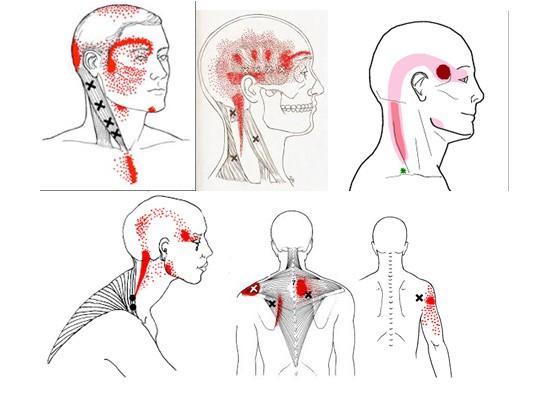 Bên cạnh chóng mặt bạn có thấy đau ở những điểm mà chúng tôi bôi đỏ trong hình không?