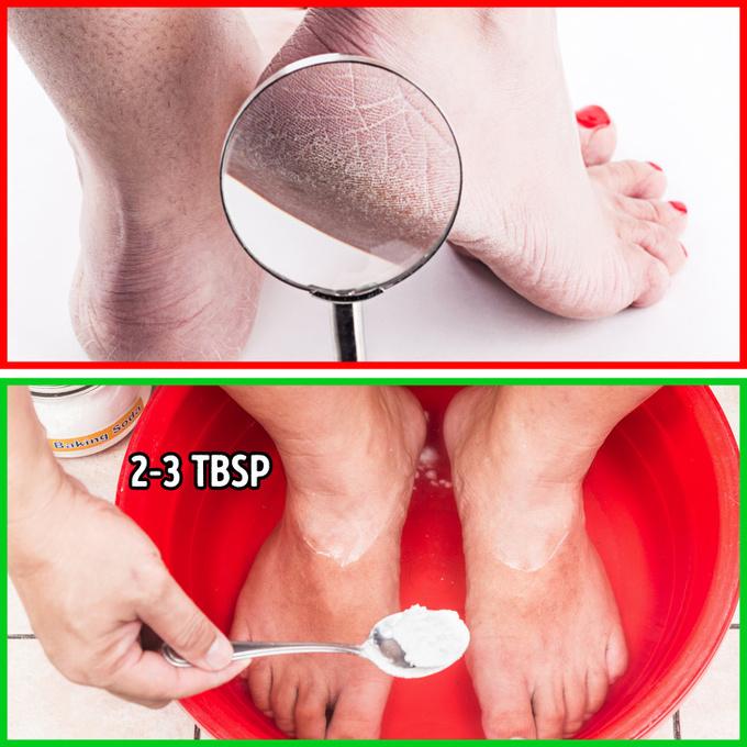 Trị gót chân khô nứt   Ngâm chân với baking soda là cách hữu hiệu để loại bỏ da chết, giảm tình trạng khô nứt ở gót chân. Cho hai thìa baking soda vào chậu nước nóng, ngâm chân trong 20 phút. Sau đó, lau khô chân và thoa kem dưỡng.