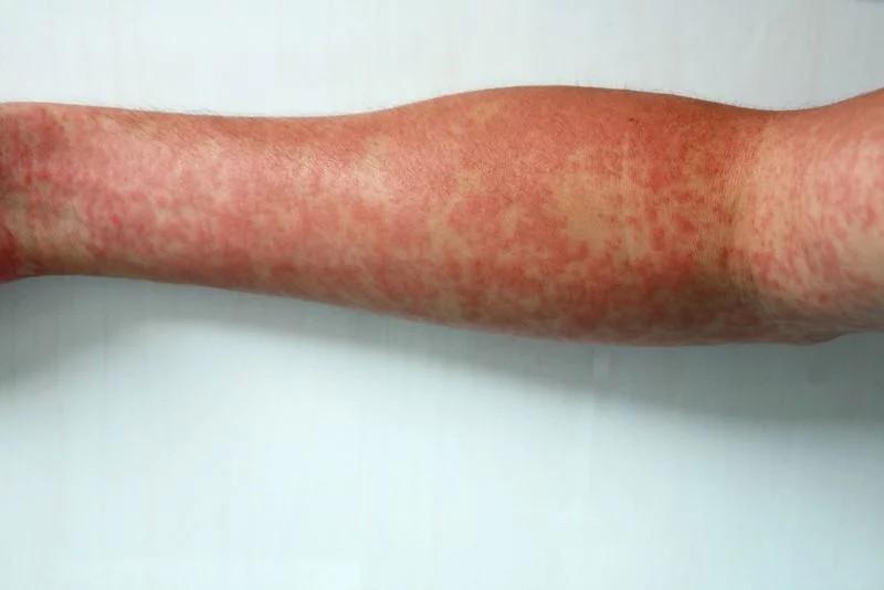 Phát ban trên da: Một triệu chứng thường thấy khác của sốt xuất huyết dạng nhẹ là nổi ban đỏ trên da. Triệu chứng này thường xuất hiện 3 đến 4 ngày sau khi lên cơn sốt. Các vết ban đỏ ban đầu xuất hiện trên mặt, sau đó lan dần xuống cổ rồi lan ra khắp vùng ngực, cánh tay và thậm chí xuống cả chân. Một dạng phát ban khác của sốt xuất huyết là các cụm đỏ xuất hiện ở bất kì đâu trên cơ thể khi cơn sốt bắt đầu. Các vết ban thường không gây ngứa. Tuy nhiên, ở một số ca ít gặp, bệnh nhân có thể nổi mẩn ngứa ở bàn tay hoặc bàn chân. Các vết ban đỏ thường tự biến mất sau đó lại đột ngột xuất hiện.