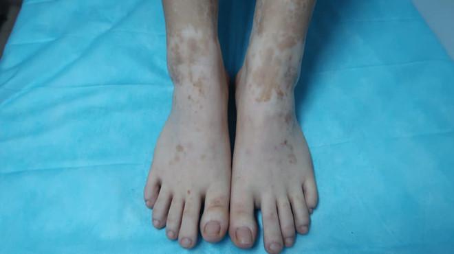 Hai chân của nữ bệnh nhân sau khi ngâm trong nước lá trầu không