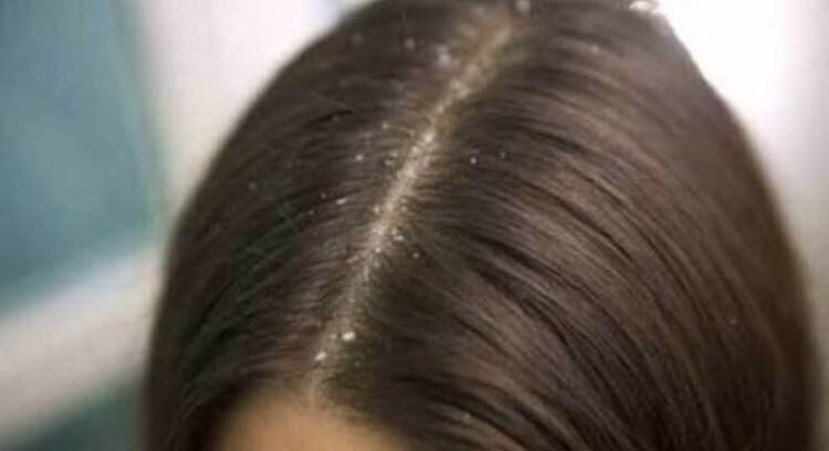 Đừng sử dụng quá nhiều sản phẩm tạo kiểu tóc trong mùa Đông, bởi da đầu vốn khô và tóc lại thiếu độ ẩm, chúng có thể bị ảnh hưởng bởi hóa chất và dẫn tới ngứa da đầu, từ đó khiến nhiều gàu hơn.