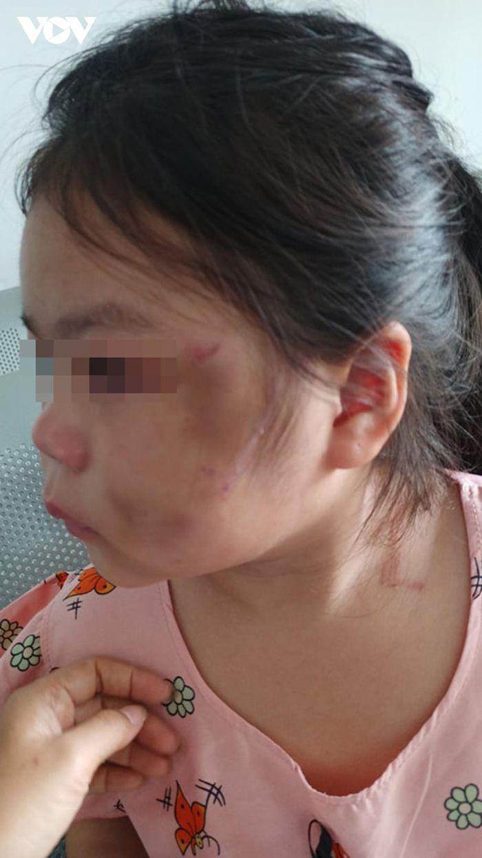 Bé gái 6 tuổi ở Bình Dương bầm tím người vì cha ruột 