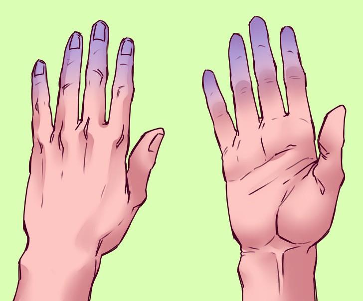 Kết quả thứ 2: Nếu đầu ngón tay của bạn trở nên nhợt nhạt hoặc tím tái, bạn có thể có vấn đề về lưu thông máu. Điều này xảy ra khi lượng oxy trong các tế bào hồng cầu của bạn thấp hoặc do bạn gặp vấn đề về tim mạch. Trong trường hợp này, bạn có thể làm ấm hoặc xoa bóp để các ngón tay trở lại bình thường. Nếu tình trạng các ngón tay vẫn không thay đổi, bạn nên đi khám bác sĩ. Trong trường hợp các ngón tay tím tái đi kèm triệu chứng thở dốc, đau đầu, đau ngực, tê tay, chóng mặt... bạn nên gọi cấp cứu.