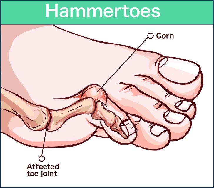 "Ngón chân búa": Khi các ngón chân thường xuyên bị nhồi nhét và chịu sức ép của trọng lực, chúng sẽ bị đau đớn vì các tổn thương khớp nối.