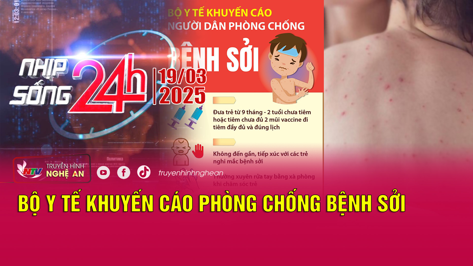 Bản tin Nhịp sống 24h - 19/03/2025: Bộ Y tế khuyến cáo phòng chống bệnh sởi