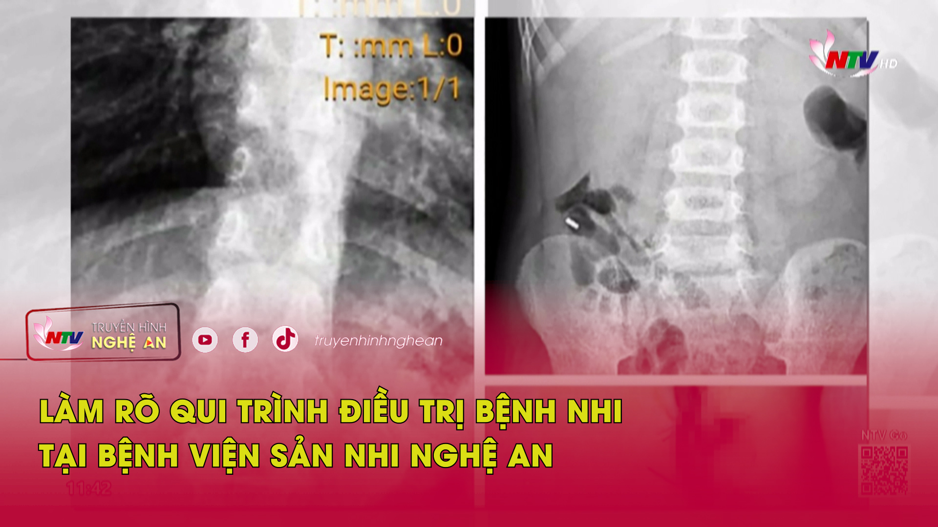 Làm rõ qui trình điều trị bệnh nhi tại Bệnh viện Sản Nhi Nghệ An