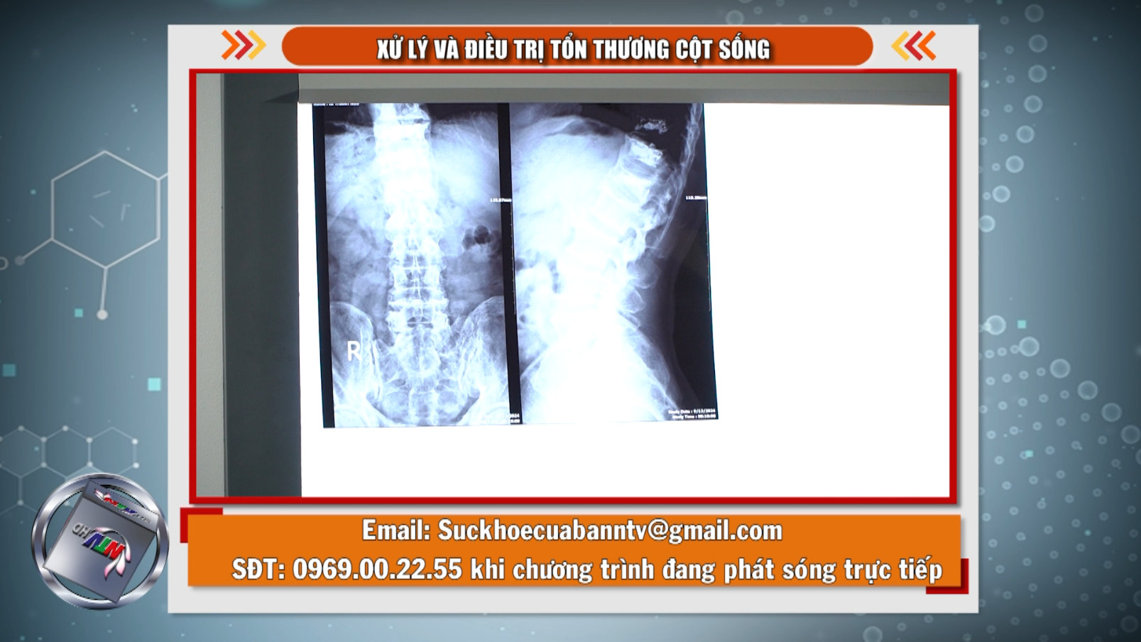 Trực tiếp - Sức khỏe của bạn: “Xử lý và điều trị tổn thương cột sống”