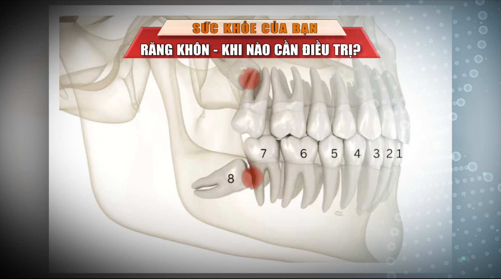 [🔴Trực tiếp] Sức khỏe của bạn: Răng khôn - Khi nào cần điều trị?